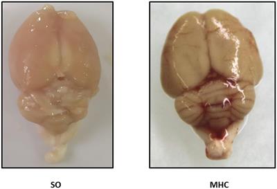 Hepatic Encephalopathy-Associated Cerebral Vasculopathy in Acute-on-Chronic Liver Failure: Alterations on Endothelial Factor Release and Influence on Cerebrovascular Function